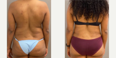 39 year old woman treated with Liposuction, Tumescent Liposuction and SAFE Liposuction - 39 year old woman treated with Liposuction, Tumescent Liposuction and SAFE Liposuction