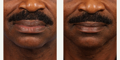 45-54 year old man treated with Lip Reduction - A common request for African American patients