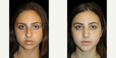 25-34 year old woman treated with Genioplasty, Rhinoplasty - 25-34 year old woman treated with Genioplasty, Rhinoplasty