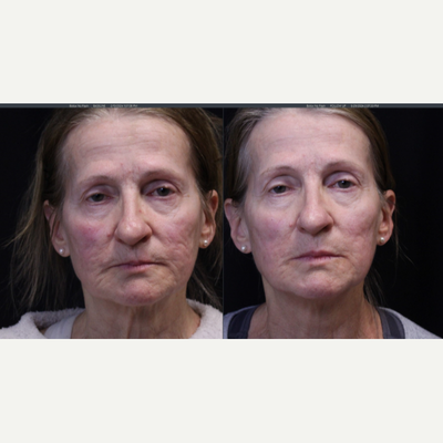 65-74 year old woman treated with Fractional Laser, Laser Resurfacing, Laser Scar Removal, Scar Removal, Skin Rejuvenation, Skin - 74 yrs old with severe atrophic acne scarring with tethering and deep depressions on both cheeks. LASERCORING with Ultraclear and subcision with Sculptra and PRP resulted in amazing results.