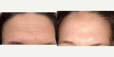 45-54 year old woman treated with eMatrix - Our client had her forehead treated with Sublative ematrix. The picture shown is one week post treatment.
