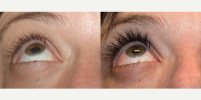35-44 year old woman treated with Latisse - This patient grew beautiful long, full eyelashes with Latisse.