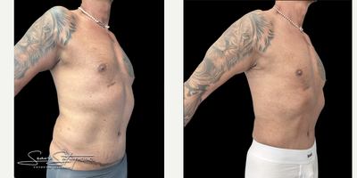 55-64 year old man treated with Abdominal Etching, Liposuction, Lymphatic Massage, Renuvion, Scar Removal, Skin Tightening, Vase - 55 year old gentleman who underwent VASER assisted liposculpting and Renuvion J plasma skin tightening of the abdomen, flanks, chest, axilla, lower back; chest masculinization procedure with fat grafting to the chest.