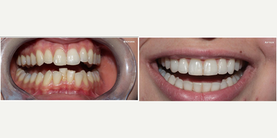 Fast Braces - This patient had Dental Braces for 4 months.Normal metal braces were used to produce this result. The `Social Six` - 6 front teeth were straightened only, Invisalign, C Fast, Quick Straight Teeth are all brands of dental braces, that can be used to improve the smile needed.