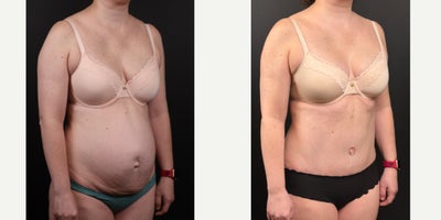 35-44 year old woman treated with Tummy Tuck, Diastasis Recti Repair, Umbilical Hernia Repair, Liposuction - This 38 year old woman is 5'3 and 138 pounds. She has been pregnant 5 times, had 4 children, 3 of them by C-section. She has a wide diastasis recti, (separation of the abdominal muscles), and even ventral and umbilical hernias. She had an abdominoplasty with repair of rectus diastasis and hernias, as well as some liposuction of the flanks.