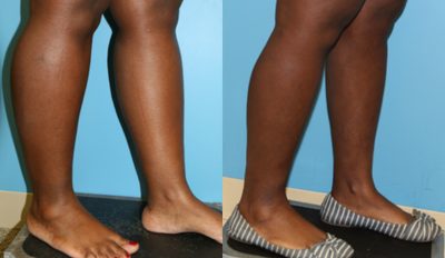 35-44 year old woman treated with Calf Reduction - This patient was unhappy with the width of her calves. She had trouble finding tall boots that fit and wasn't seeing changes with weight loss or gain. She was treated with calf liposuction.
