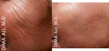 55-64 year old woman treated with Venus Viva - Venus Viva, is a device that allows us to gain the results of full face laser resurfacing without the downtime and risks. Venus Viva is like getting a CO2, Erbium, Fraxel and VBeam laser all in one. The Viva device uses patented nanofractional radiofrequency and SmartScan technology to deliver energy to the dermis. This generates heat in a controlled manner to initiate skin change, rebuilding collagen and fibroblast stimulation, all resulting in tissue remodeling. This achieves results with minimal discomfort and very little to no downtime.