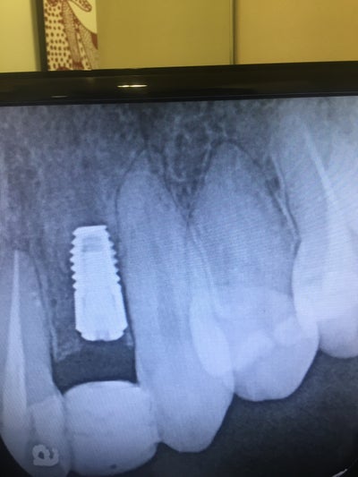 after-removing-dental-implant-i-m-having-pain-is-this-normal-how-long