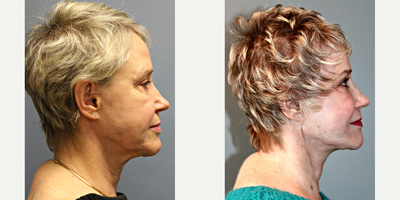68 year old woman treated with Blue Peel - This 68 year old patient underwent a LiteLift, along with an upper and lower eyelid lift, temple lift, facial fat transfer, blue peel, and platysmaplasty. Through a hairline incision hidden within the ear, under general anesthesia, the doctorreduced the signs of aging around the jaw, neck, and lower face.