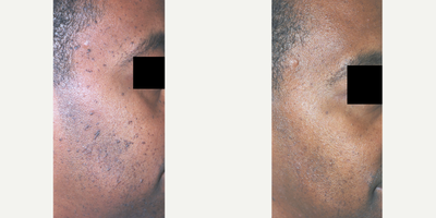 Mole Removal African Skin, Dermatosis Papulosa Nigra, Los Angeles, Before and After Photos - This gentleman had a very specific type of mole removal.  Dermatosis Papulosa Nigra is a slightly raised, small dark mole that is common in African Americans and Asians.  Quick and easy to remove, although more develop over time as we age.