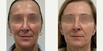 55-64 year old woman treated with Fraxel Laser - This patient received 3 treatments of Fraxel to the face.
