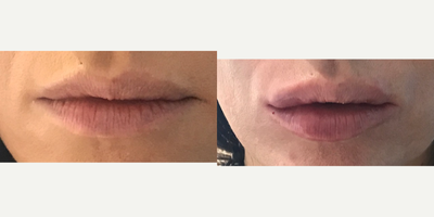 35-44 year old woman treated with Teosyal - I syringe of Teosyal Kiss.