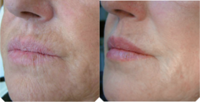 35-44 year old woman treated with Dermapen - Dermapen with Mirconeedling