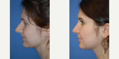 25-34 year old woman treated with Rhinoplasty - This patient had an overly long nose that was shortened to a natural length