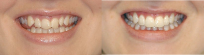 Adult Orthodontics with Clear Braces - 39 years female treated with crowding. Patient was treated with clear braces. Treatment took 6 months followed by bonded retainer