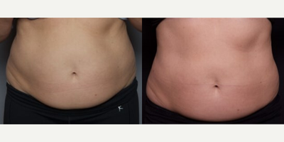 45-54 year old woman treated with SculpSure - This patient came in wanting to contour her abdomen. After consulting with one of our aestheticians, the patient elected to have a SculpSure treatment.
