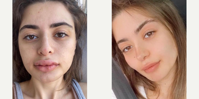 25-34 year old woman treated with Facial Fat Transfer - 25-34 year old woman treated with Facial Fat Transfer as well as Buccal Fat Removal, shown 3 months post op. Pre-op, patient was sad because of the shape of her face and wanted to have prominent cheeks.