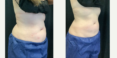 Woman treated with Cryolipolysis - Pre-Treatment vs Post-Treatment CoolSCulpting Elite. This patient had 2 rounds of CoolSculpting, 4 weeks apart.