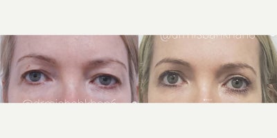 Woman treated with Fractional Laser - Woman treated with Fractional Laser