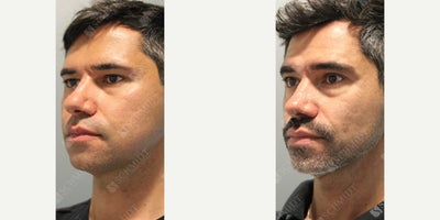 Man treated with Buccal Fat Removal - Subtle transformations for a refined, natural look! This patient desired a subtle change and came in with specific goals: to reduce the fullness in his cheeks, enhance definition in the cheek areas, bring symmetry, and reduce the bulbosity of his nose without losing his masculine appearance. Through cosmetic rhinoplasty, I narrowed and carefully reshaped the nasal tip for enhanced symmetry, performed a septoplasty for improved function, and added cartilage grafts to strengthen airflow. Right and left buccal fat reduction added just the right amount of contour to his cheeks, bringing balance and definition to his entire face. He is shown two years post-op and still enjoying his results.