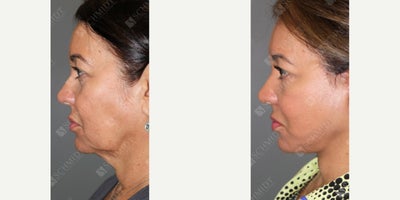 Woman treated with Facelift - Restore your youthful contours! This beautiful patient wanted to refresh her appearance while preserving her natural beauty. With a facelift, I achieved a balanced, youthful result by addressing sagging skin and restoring the underlying facial structure. Its always rewarding to see how subtle enhancements can make such a big impact.