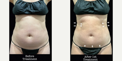 Woman treated with SculpSure - Woman treated with SculpSure