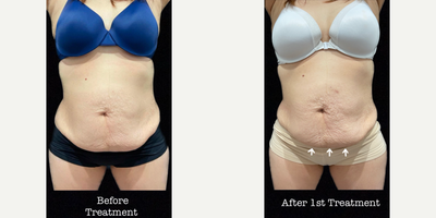 Woman treated with SculpSure - Woman treated with SculpSure