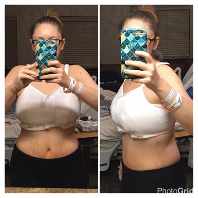 34DD Breast Reduction , Not Small Enough - Review - RealSelf