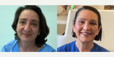 50 year old woman treated with Deep Plane Facelift - 50 year old woman treated with Deep Plane Facelift as well as Neck Lift, Eyelid Surgery, Rhinoplasty, Lip Lift and Facial Fat Transfer, shown 3 years post op.