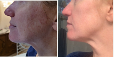 45-54 year old woman treated with Cryoskin - With Cryo was able to give amazing chin definition as well as amazing skin rejuvenation Pico