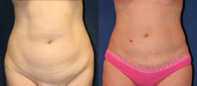 35-44 year old woman treated with Liposuction - 37 year old female with Liposuction of the Abdomen, Hips, Upper Back and Pubic Mons