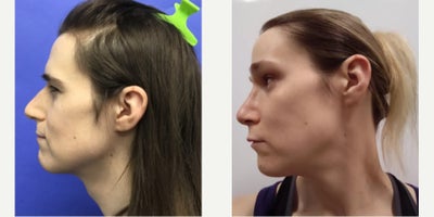 35-44 year old transgender woman treated with Brow Lift, Forehead Reduction, Septoplasty, Cheek Augmentation, Adam's Apple Reduc - 35 to 44 year-old female patient is 1 year post-op from Facial Feminization surgery. Her procedures included: Forehead Lift, Hairline Lowering, Supra Orbital Bone Reduction and Contouring, Septorhinoplasty (closed) with Cartilage Grafts and Weirs, Cheek Implants (small combined), Chin Reduction and Contour, Thyroid Cartilage Shave, 300 Micrografts to the Frontotemporal Recessions, Lip Lift, Fascia to Lips, Soft Tissue to Nasolabial Folds, Lower Eyelid Blepharoplasty (TC), and 1 cc Juvederm to Facial Rhytids.