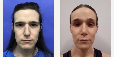 35-44 year old transgender woman treated with Brow Lift, Forehead Reduction, Septoplasty, Cheek Augmentation, Adam's Apple Reduc - 35 to 44 year-old female patient is 1 year post-op from Facial Feminization surgery. Her procedures included: Forehead Lift, Hairline Lowering, Supra Orbital Bone Reduction and Contouring, Septorhinoplasty (closed) with Cartilage Grafts and Weirs, Cheek Implants (small combined), Chin Reduction and Contour, Thyroid Cartilage Shave, 300 Micrografts to the Frontotemporal Recessions, Lip Lift, Fascia to Lips, Soft Tissue to Nasolabial Folds, Lower Eyelid Blepharoplasty (TC), and 1 cc Juvederm to Facial Rhytids.