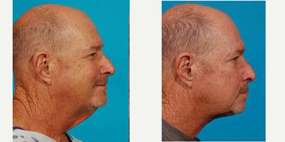 65-74 year old man treated with Neck Lift - 65 year old male interested in getting rid of excess neck skin consulted with the doctor who recommended an in-office 'Direct Neck Lift. The procedure is performed in the office versus the surgery center under a local anesthetic. The patient with the result and the recovery time was easy to manage. This is his result 10 days after his surgery.