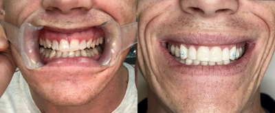 35-44 year old man treated with Durathin Veneers - Stained worn crooked teeth restored with Invisalign clear aligner braces, dental veneers and custom blue diamond inserts.