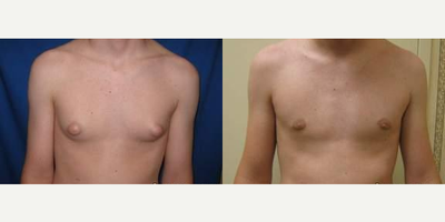 25-34 year old man treated with Male Breast Reduction - 25-34 year old man treated with Male Breast Reduction