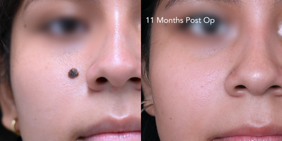 18-24 year old woman treated with Mole Removal via Excision - Take a look at these amazing results. This patient underwent mole removal via Excision with Dr. Khorasani. For more information, please visit Dr. Khorasani's website at: https://www.drkhorasani.com/before-and-after-gallery/cosmetic-mole-removal