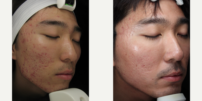 25-34 year old man treated with Intracel - Cheeks and temples Intracel treatment