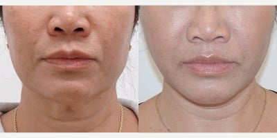 MACS Facelift, Facelift San Francisco, L Plastic Surgery by Charles K Lee - Patient recently underwent a MACS Facelift procedure performed by Dr. Charles Lee. The patient, delighted with the outcome, expressed satisfaction with the results. Dr. Lee, a renowned plastic surgeon, successfully enhanced the patient's facial features, providing a rejuvenated and youthful appearance. The procedure, conducted with precision and expertise, left the patient feeling more confident and pleased with the transformation.