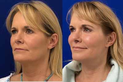 57 year old woman treated with Brow Lift - 57 year old woman treated with Brow Lift, shown 6months post op. Patient also underwent Eyelid Surgery, Lower Facelift, Neck lift, Lip Lift, Fat Transfer and CO2 laser.