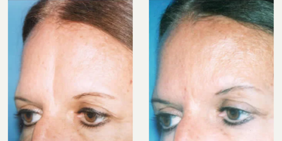 Woman treated with Radiesse - Woman treated with Botox, Juvederm, and Radiesse. Pre-op, patient suffered from an extremely deep and long frown line, slightly asymmetric on her left side.