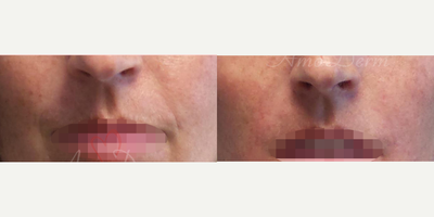 35-44 year old woman treated with Juvederm, Vollure - Treatment of nasolabial folds (laugh lines) and marionette lines with Juvederm, Radiesse, Vollure, Restylane or Bellafill injected with cannula