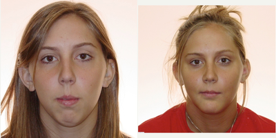 Anterior Openbite With Recessed Mandible (Lower Jaw) Treated With Orthognathic Surgery - Treatment time: 2 years  She had a hard time closing her lips and because her lower jaw was recessed, she had a very week chin.  Upper and lower jaw surgery was performed to close her bite and bring her lower jaw forward.