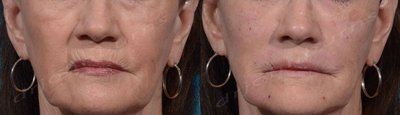 Volbella - Juvederm: 2.0cc to Nasolabial Folds, Oral Commissures, and Marionette Lines. Volbella: 1.2cc