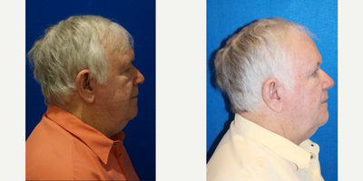 Man treated with Brow Lift - Brown Lift