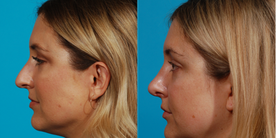 35-44 year old woman treated with Rhinoplasty - 35 year old woman unhappy with the appearance of her nose, sought the help of board certified doctor. Using the digital imager as tool to show changes that can be made with tip rotation and dorsal fullness, patient was able to see the changes that could be made.