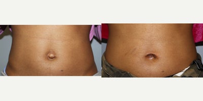 25-34 year old woman treated with Belly Button Surgery - 14518: Umbilicoplasty25 y/o F, G0P0, 50, 101 lbs