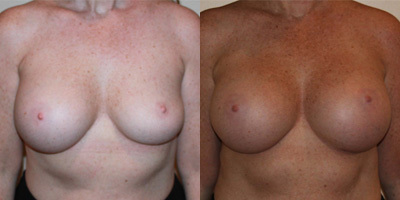 Breast Augmentation Revised - Breast Augmentation Revised