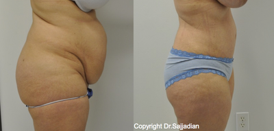Tummy Tuck - Tummy Tuck