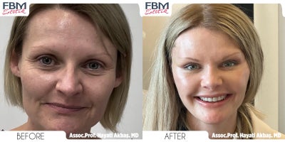 45-54 year old woman treated with Canthoplasty 7 days post op - 45-54 year old woman treated with Canthoplasty 7 days post op